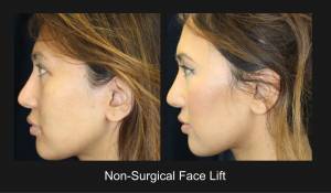 Non Surgical Face Lift 3 Nazarian Plastic Surgery