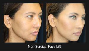 Non Surgical Face Lift Nazarian Plastic Surgery