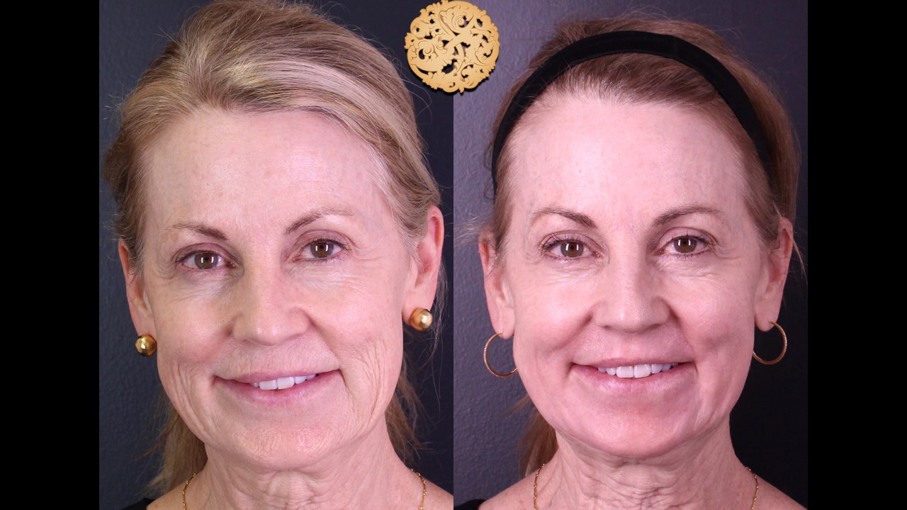 Before and after facial rejuvenation treatment showcasing smoother skin and reduced wrinkles on a mature woman, demonstrating effective anti-aging procedures