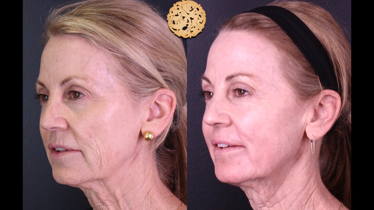 Side-by-side comparison of Profractional laser skin rejuvenation results on a woman, showcasing clear skin improvement