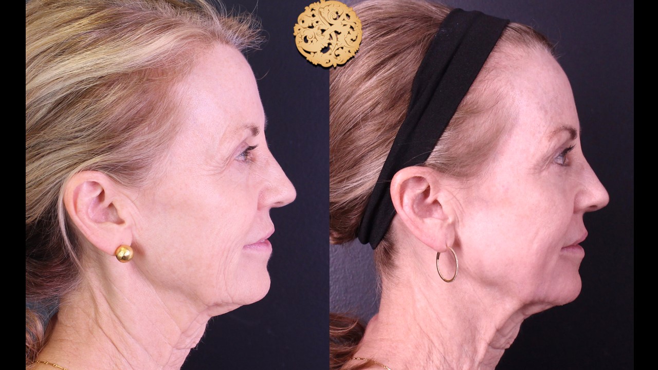 Aging woman's profile comparison before and after Profractional laser skin resurfacing treatment, showing visible reduction in wrinkles and skin tightening