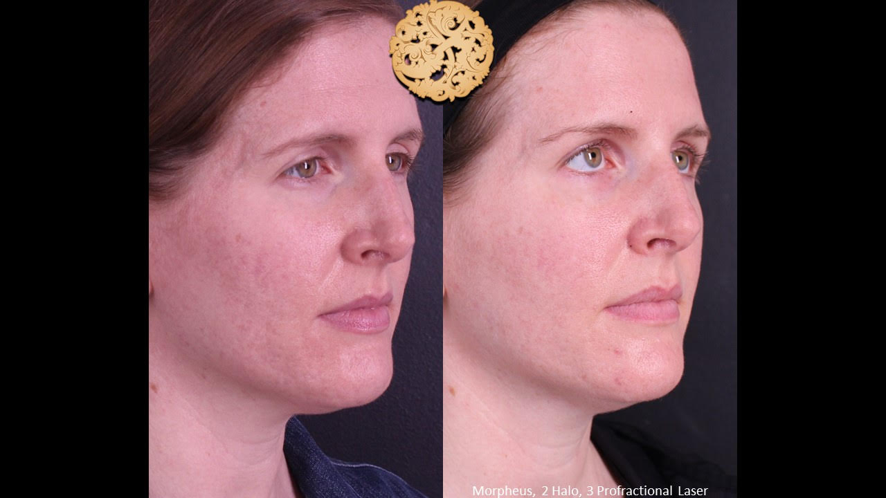 Female patient's skin transformation result before and after Morpheus, Halo, and Profractional laser treatment