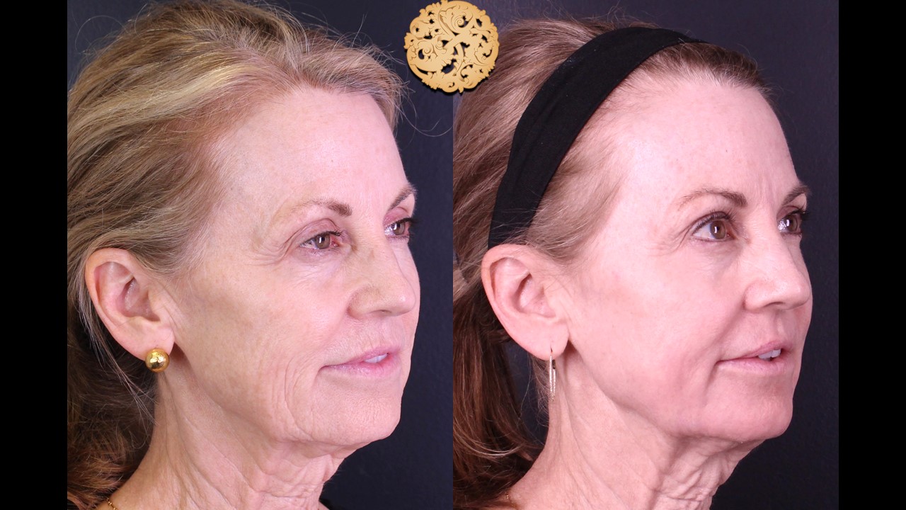 Before and after images of an elderly woman showing rejuvenated skin following Profractional laser therapy, highlighting the reduction in lines and improved skin texture.