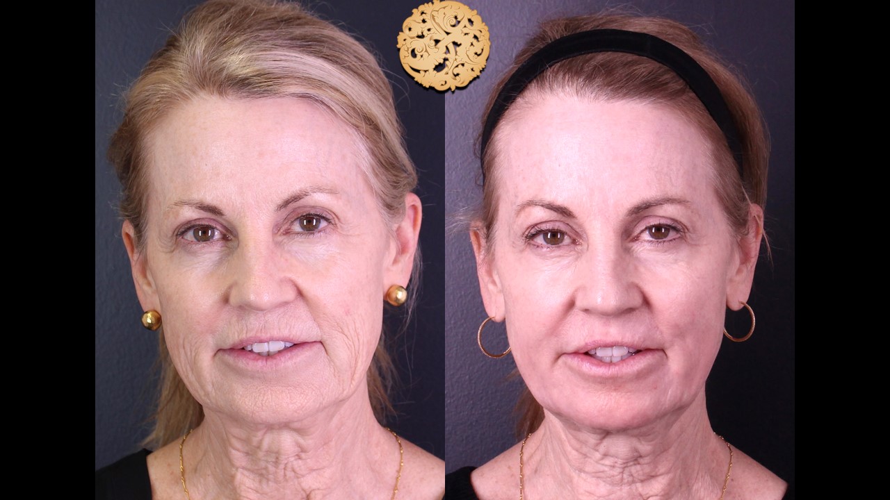Before and after results of ProFractional laser treatment on an elderly woman's face, showing skin rejuvenation