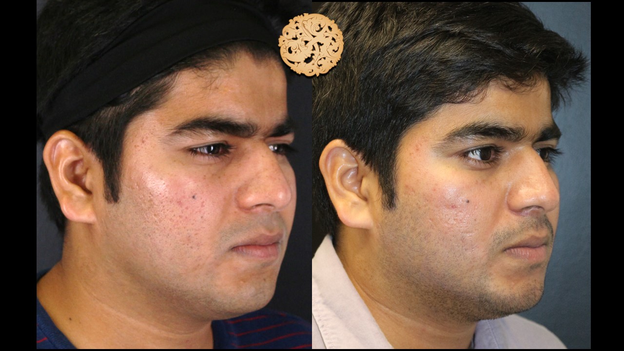 Frontal and side comparison of a young male before and after profractional surgery showcasing skin clarity and acne scar reduction