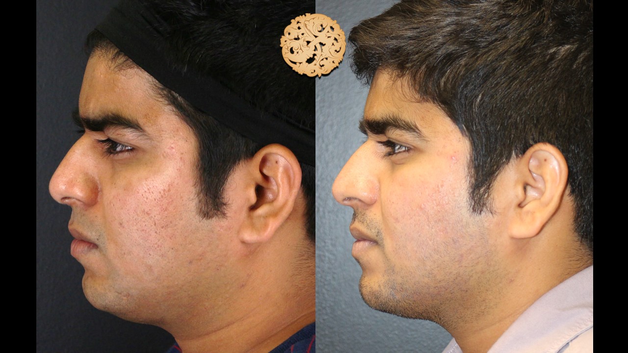 Profile view before and after profractional treatment on a young man demonstrating significant skin texture improvement and blemish reduction