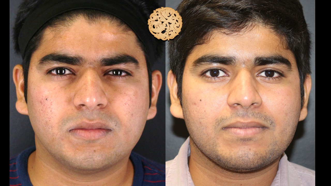 Before and after profractional laser skin treatment on a young man showing clear complexion and acne reduction, illustrating dermatological care effectiveness