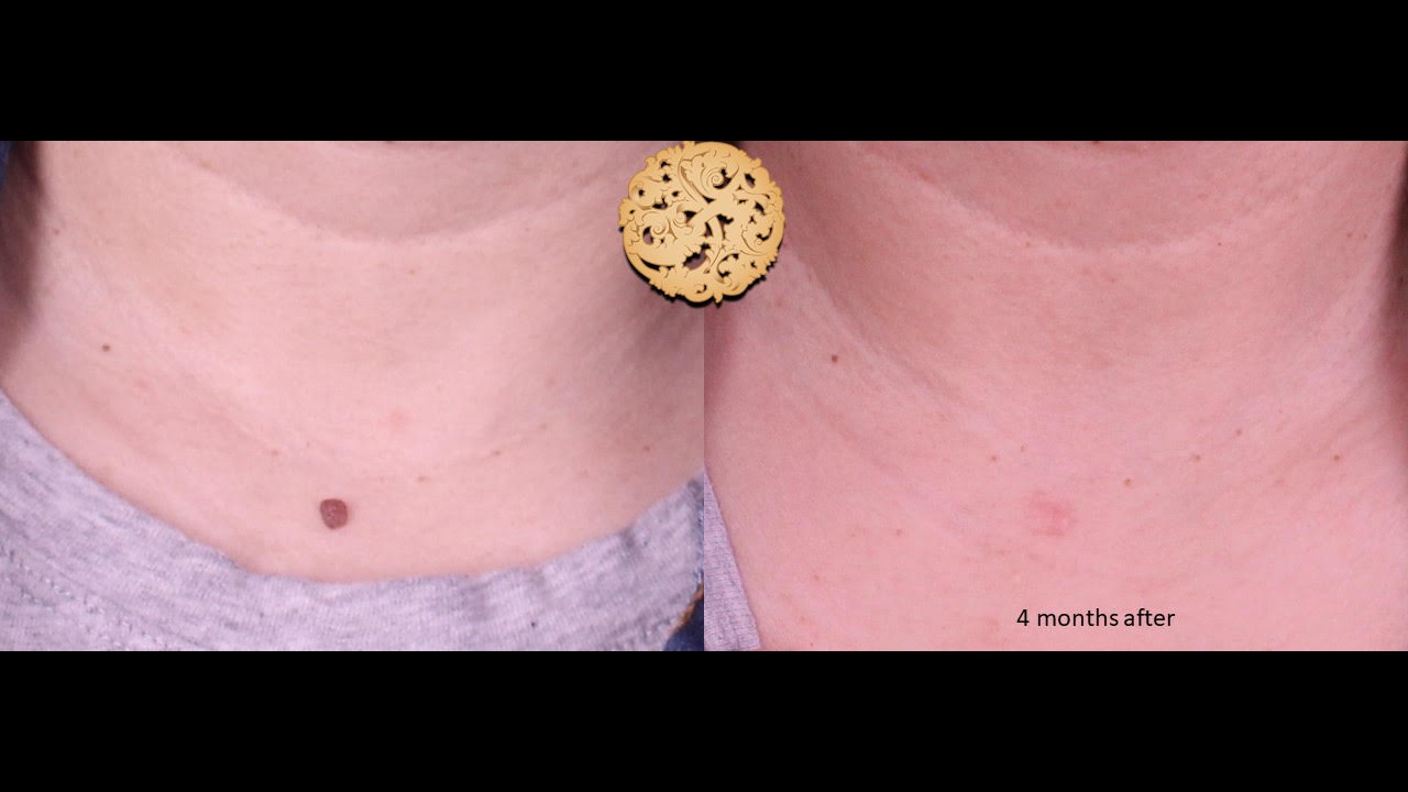 Before and after results of Plexr neck treatment showing mole removal after 4 months