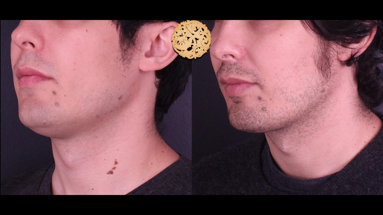 Profile view of a male's lower face showing Plexr treatment results with noticeable skin improvement
