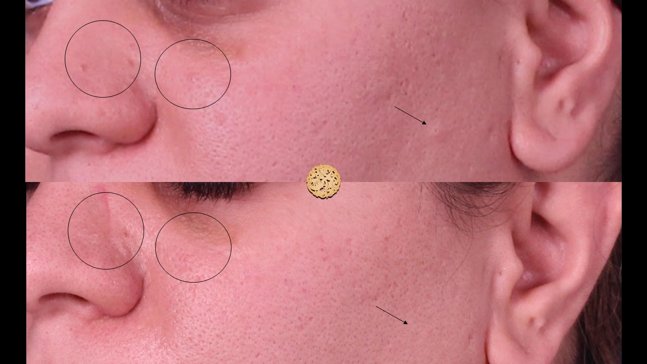 Before and after comparison of Plexr treatment showing improvement in skin texture and pore size