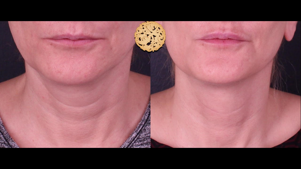 Restylane Filler Injections