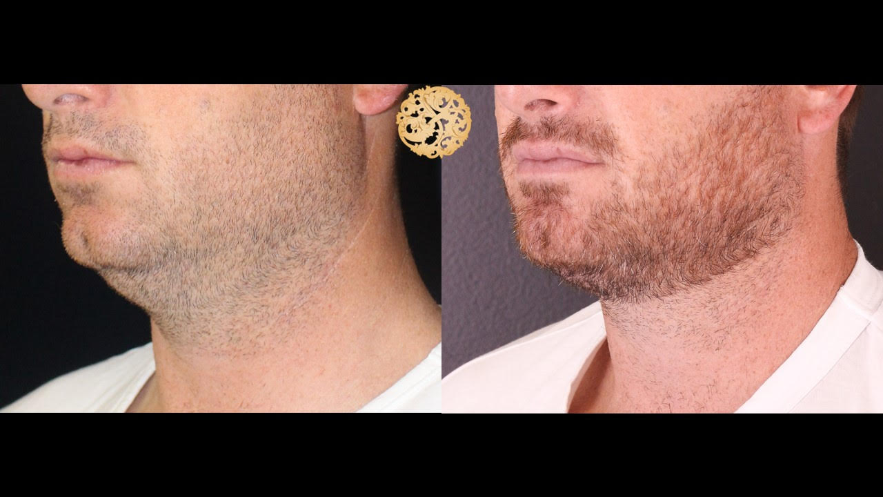 Male chin liposuction treatment before and after results, showcasing facial contouring