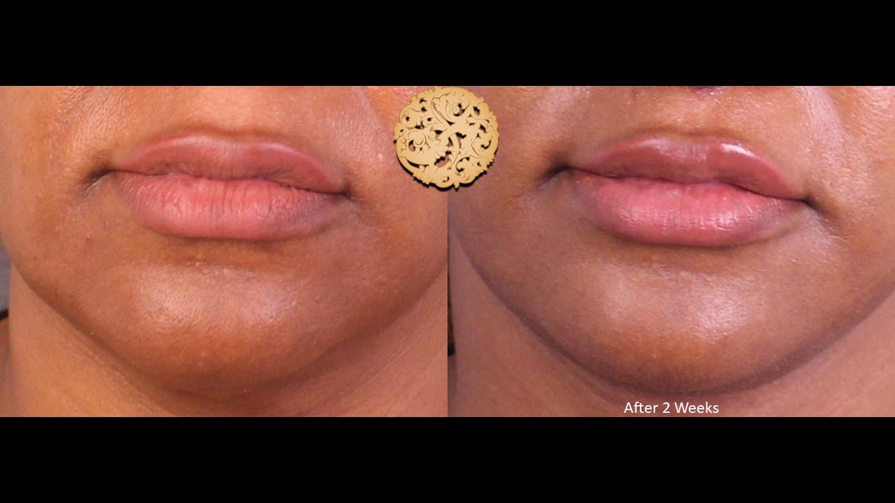 Fat Transfer to Lips