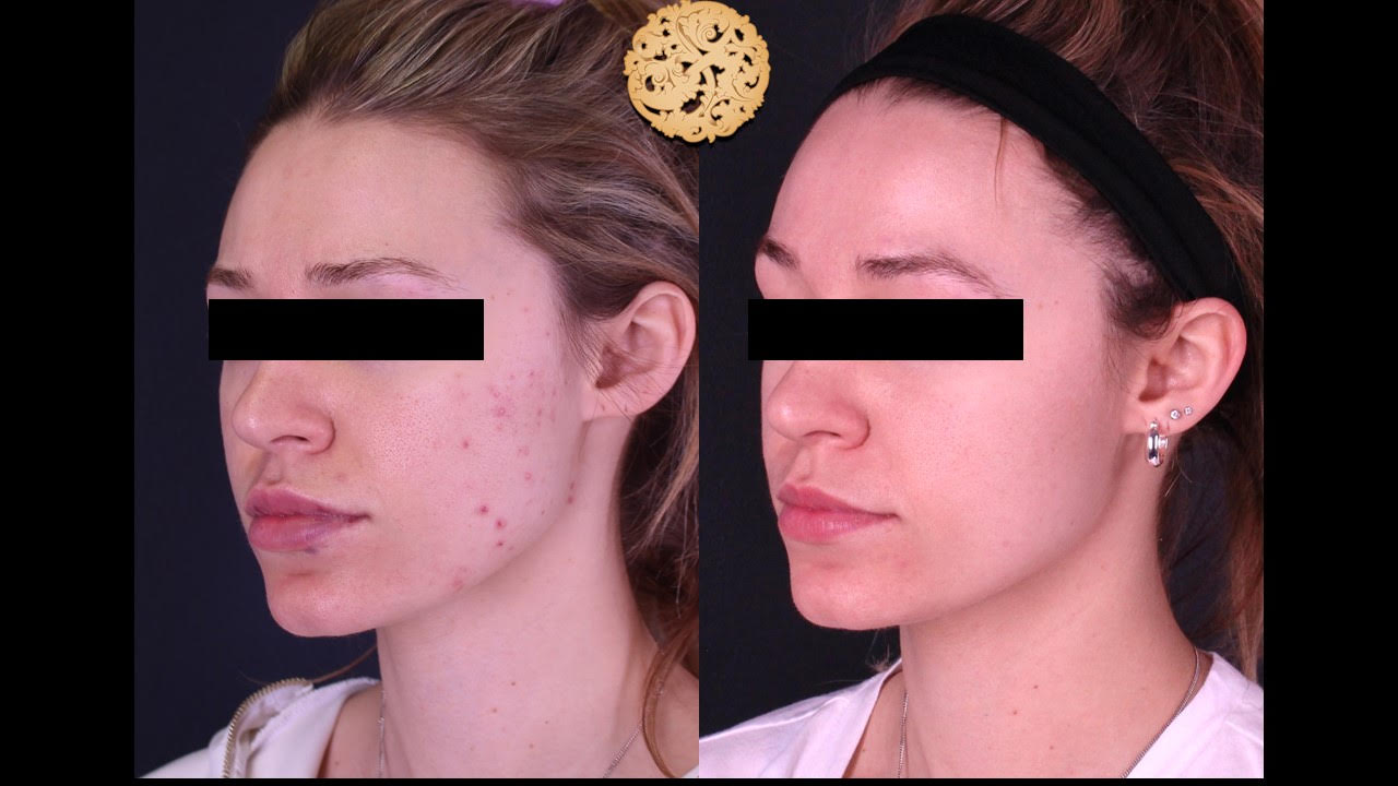 Diamond Facial Before and After