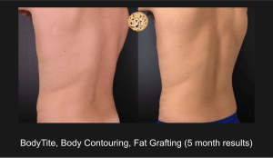 Bodytite, Body Contouring, Fat Grafting (5 Month Results)