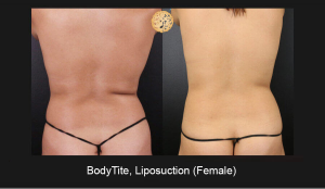 Female Bodytite, Liposuction