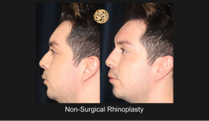 Non-Surgical Rhinoplasty
