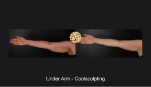 Under Arm - Coolsculpting