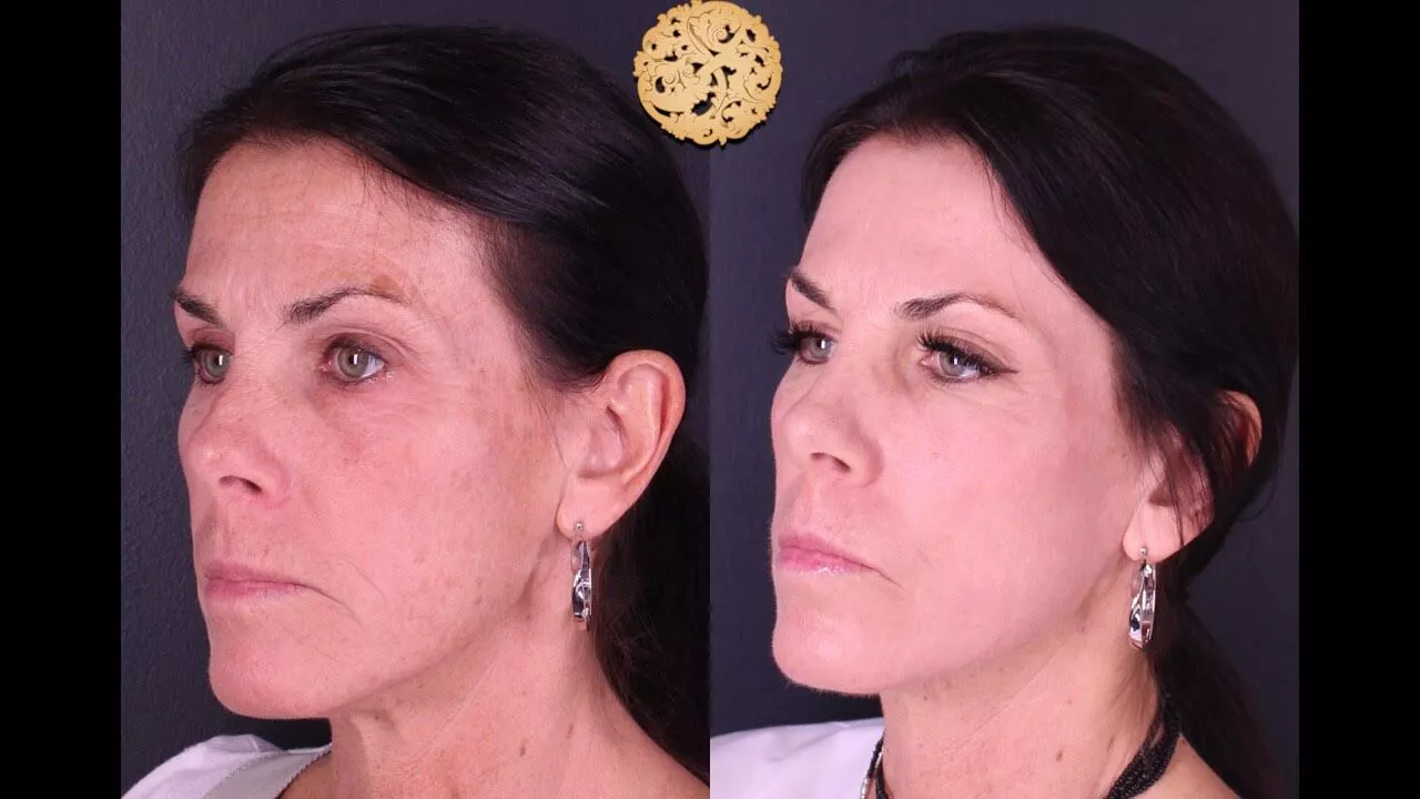 Microlaser Peel before and after