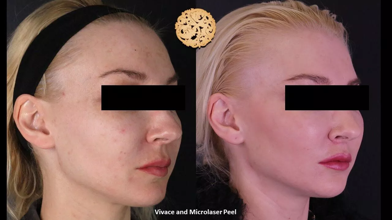 Vivace Microlaser Peel before and after