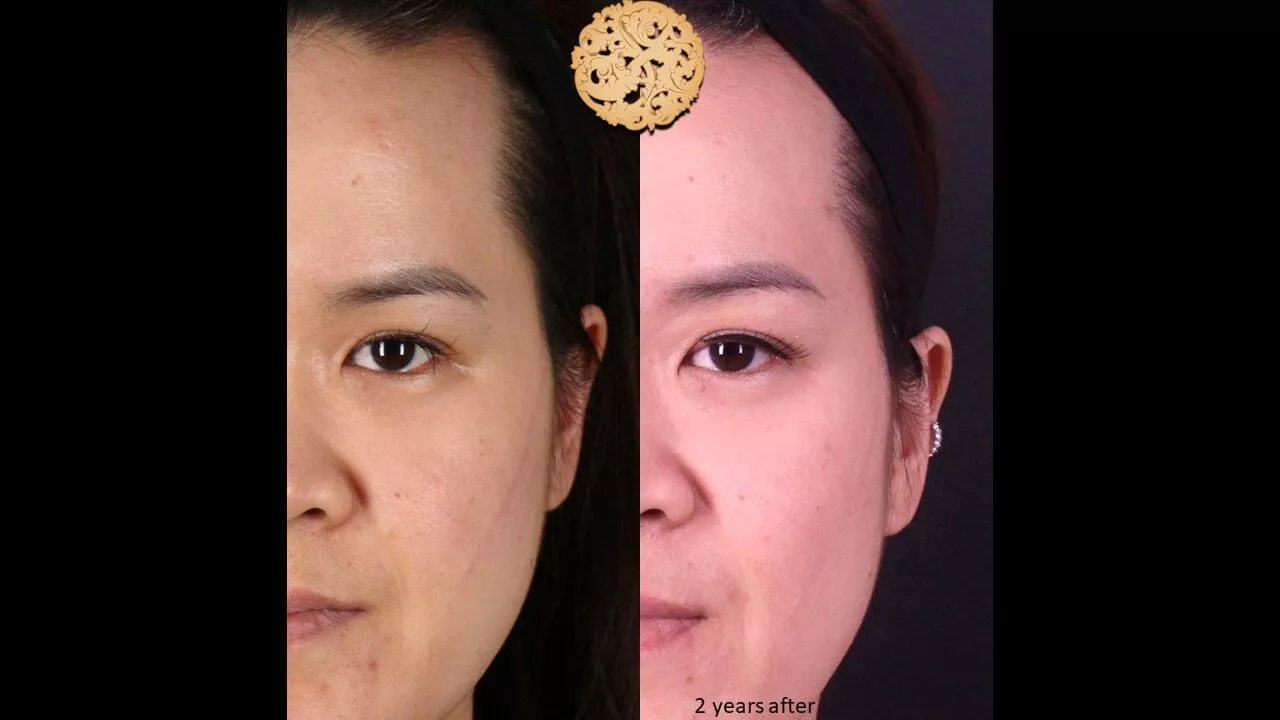 Comparative results of facial scar revision surgery, showing significant improvement in skin texture and scar appearance 2 years post-procedure