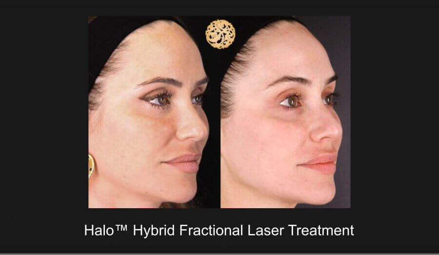 Comparison of before and after results of Halo Hybrid Fractional Laser Treatment showing significant skin improvement