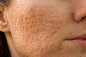 Woman Enlarged Pores And Acne Scarring
