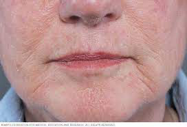 Woman Facial Skin Wrinkles