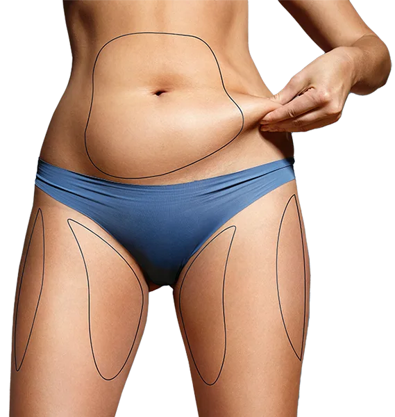 Beverly Hills Liposuction Fat Loss Los Angeles