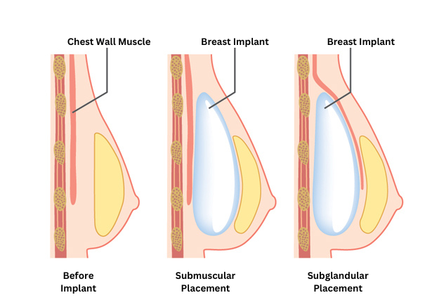 Beverly Hills Breast Implant Placement Comparison: Natural Chest Wall, Beneath Muscle (Submuscular), And Above Muscle (Subglandular) By Dr. Sheila Nazarian.