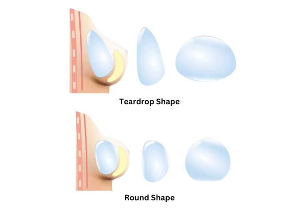 Teardrop Vs Round Shape Implant Options For Breast Augmentation By Dr. Sheila Nazarian In Beverly Hills